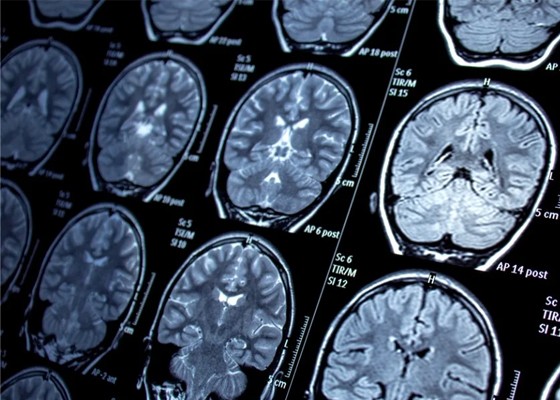 AI-facilitated Brain Tumour Segmentation in Immersive Environments