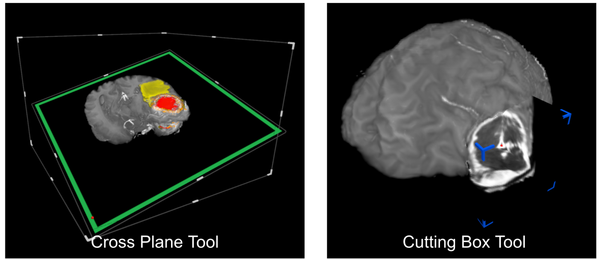 Brain Tumour Segmentation Tool Screenshots
